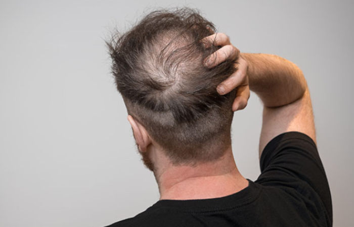 Hair Loss Treatment