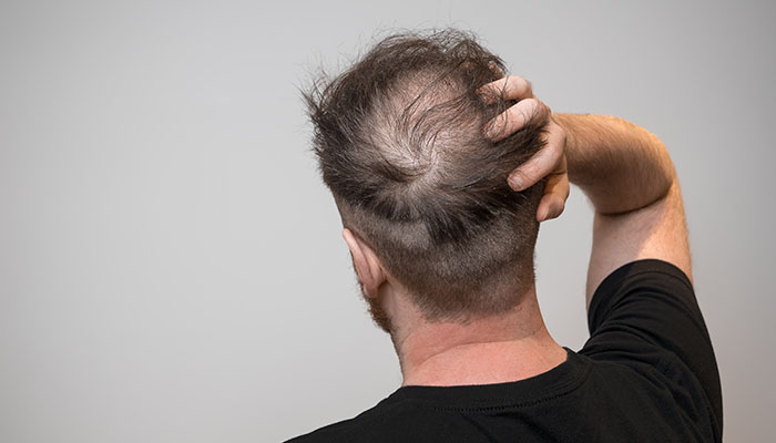 Hair Loss Treatment
